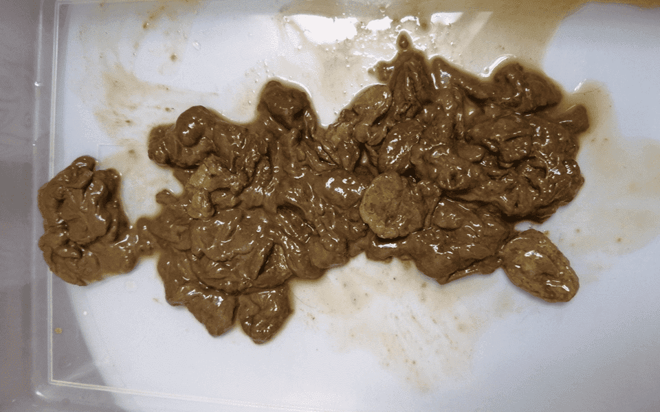 Placa Mucoide La placa mucoide se forma en el intestino